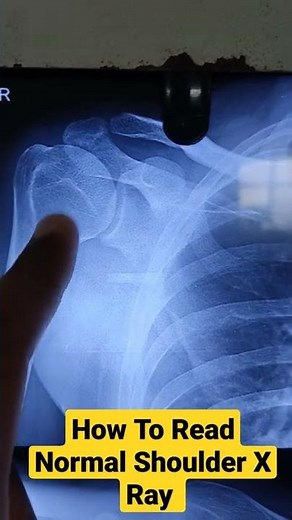 How To Read Normal Shoulder X Ray ..Dr Sai Chandra