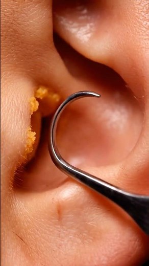 Oddly Satisfying Ear Cleaning – Soft Sticky Pull (Macro View) #asmr #satisfying #earcleaning