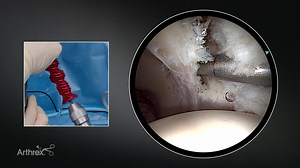 Acetabular Labral Repair Using the Pano™ Scope