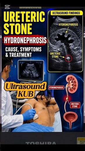 Ureter Stone Ultrasound | Hydronephrosis | Hydroureter | VUJ UVJ Stone