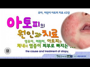 아토피 43강. 어린이 아토피의 원인과 치료. Causes and Treatment of Atopy.