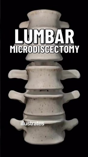 What is Lumbar Microdiscectomy