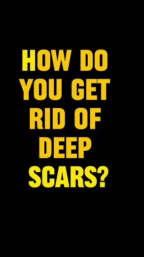 Benefits of Trichloroacetic Acid (TCA) Peel for Skin Imperfections