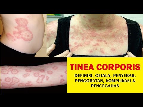 TINEA CORPORIS, Definisi, Gejala, Penyebab, Pengobatan, Komplikasi dan Pencegahan