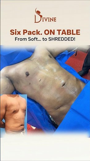On-Table Transformation: Chest Contouring & Six-Pack Abs with Advanced Male Body Sculpting