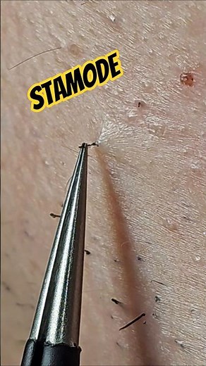 Beard Hair Removal Close-Up 🧔 #beard #tweezing #plucking #fyp