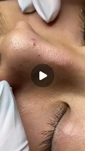Pimple Popping 2021 on Instagram: "I could watch these all day🤩 • • • • • #pimple #pimples #acne #whitehead #blackhead #blackheads #pimplesss #whiteheads #botfly #drpimplepopper #zit #blackheadremoval #popper #pimplepoppingvideos #popping #pimplesss #skincare #whiteheads #akne #bigpimple"