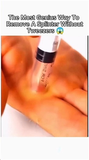 The Most Genius Way To Remove A Splinter Without Tweezers 😱