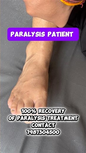 1M Views | Recovery Of Paralysis Patients 💪