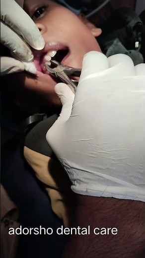 deciduous teeth extraction #doctorc#dentalprosthesis #dentalartistry