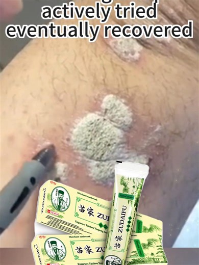 Sometimes my skin flakes and looks really annoying. #psoriasistreatment #psoriasiswarrior #zudaifu