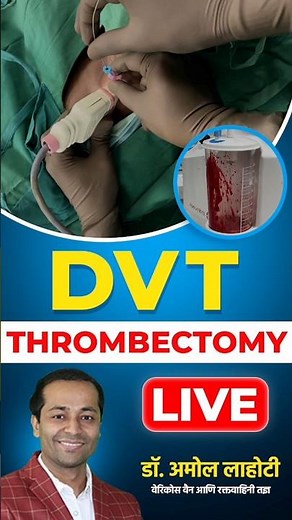 Clot Removal Surgery: Watch a Live DVT Thrombectomy #dvtawareness #viralhealthtips #shotsfeed