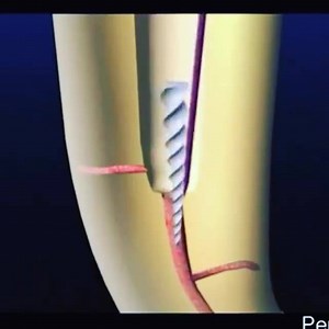 Removing fractured endodontic file inside canal! From @matteo_negri ( thank you) It sounds simple, but it is not 󾌹 No vídeo parece muito simples,mas não é 󾍅󾍅󾌹󾌹󾌹 Shared by Nilda Maria Pontes,CD | Dentist's Library