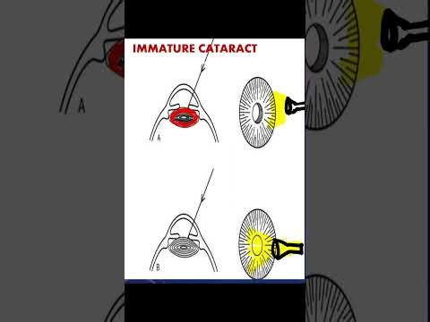 Iris shadow explained