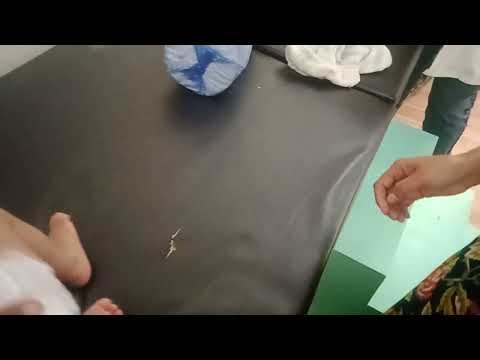 Physiotherapy tips for bowing in tibial bone