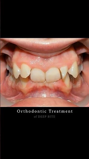 DEEP BITE in Adults for smile makeover! #braces #orthodontist #smilemakeover #dentist #orthodontics