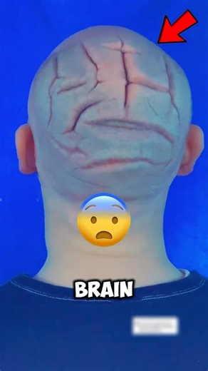 Man with Weird Head Scalp 😱 | Brain-Like Condition Explained (Cutis Verticis Gyrata)