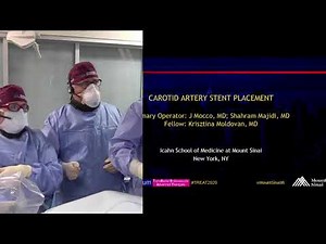 Transradial Carotid Artery Stenting