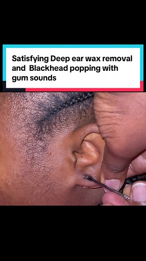 Deep Ear Wax Removal and Blackhead Popping ASMR