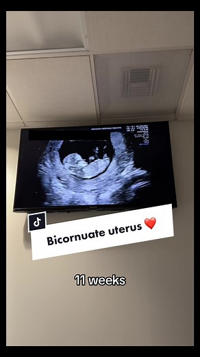 Exploring Bicornuate Uterus: Pregnancy Updates and Insights