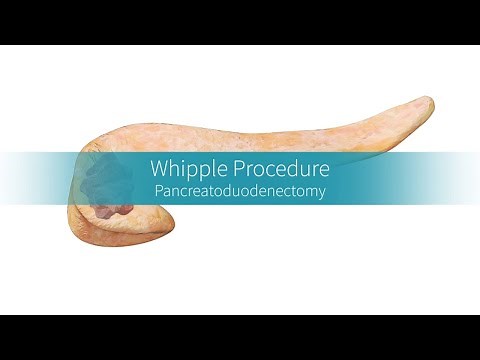 Whipple Procedure: Why and How the Surgery Is Performed