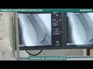 Dialysis AV Fistuloplasty Explained | Procedure, Benefits & Recovery | Dr. Sandeep Sharma