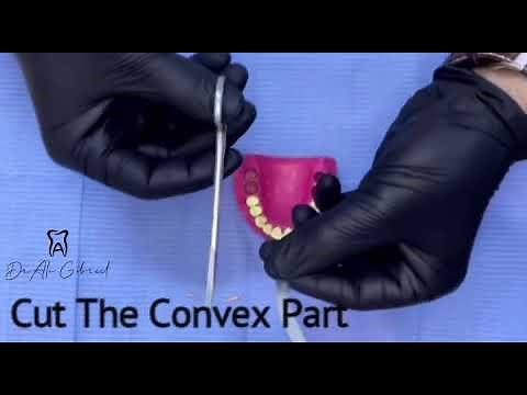 How To Use a Tofflemire Band as (UNICA MATRIX)