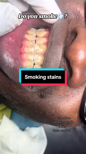 Effective Procedures for Removing Smoking Stains from Teeth