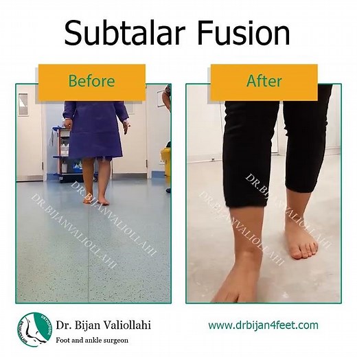 Subtalar fusion surgery