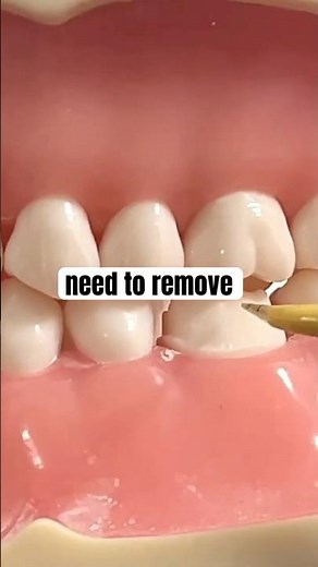 Crown Prep Marking Criteria (Exam Guide) #dentalstudents #itdonline