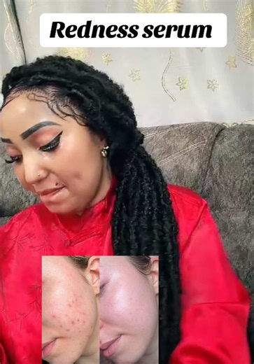 The Benefits of Redness Serum for Skin Care