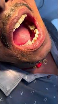 Simple tooth extraction