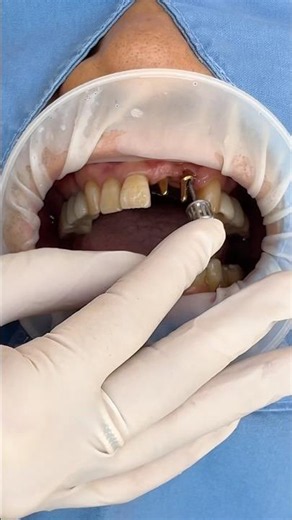 Custom Front Tooth Implant + Zirconia #dentist #dental #dentalprosthesis #dentistry #implants
