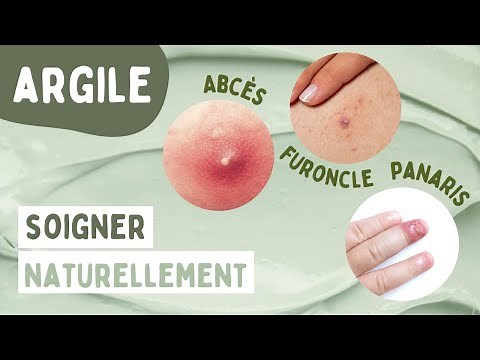 COMMENT SOIGNER NATURELLEMENT ABCÈS, FURONCLE ET PANARIS GRÂCE À L'ARGILE ? [+RECETTE CATAPLASME)