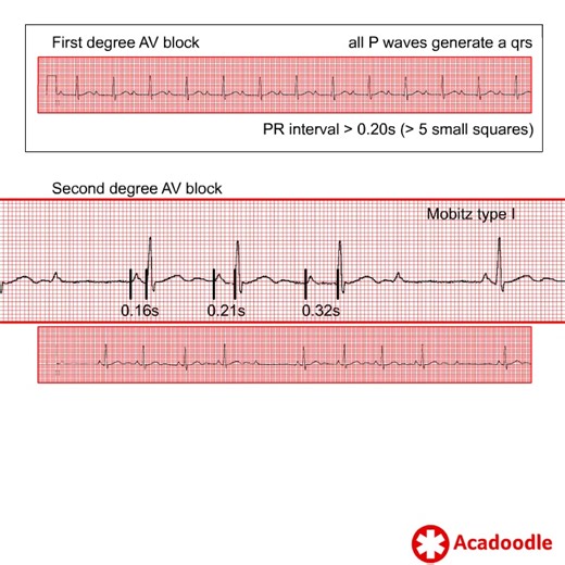 How to Recognize AV Block - Some Quick Tips - Find out more at https://acadoodle.com #emergencymedicine #intensivecare #respiratory #respiratorycare #icu #nurses #icunurse #ecg #ekg #cme #cmeonline | ECG Teacher