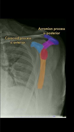 Scapula Y view #radiology #anatomy #medicine #medicalstudent #xray #shoulder #shoulderdislocation