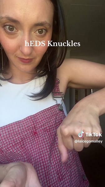 Ehlers Danlos Syndrome and Knuckle Tendons Explained