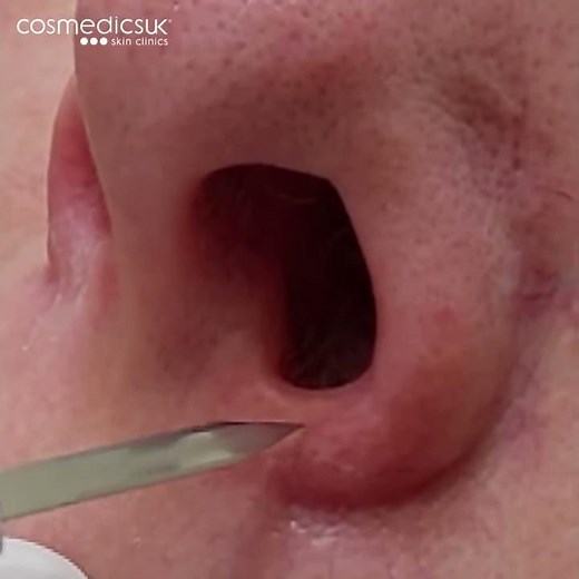 Instant thread vein removal for stubborn veins around the nose and cheeks