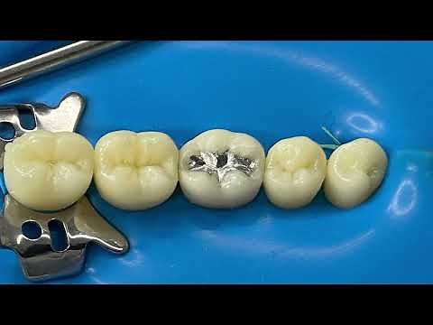 Restauração em amálgama