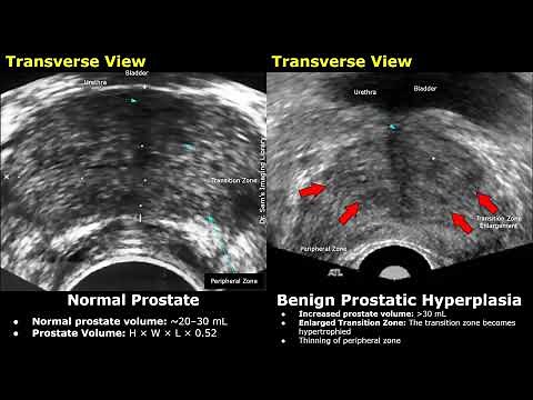 Transrectal Prostate Ultrasound Normal Vs Benign Prostatic Hyperplasia (BPH) Findings | TRUS Images