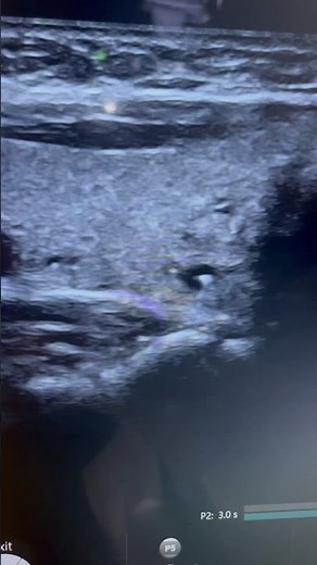 Thyroid Colloid nodule ultrasound | ARDMS sonography