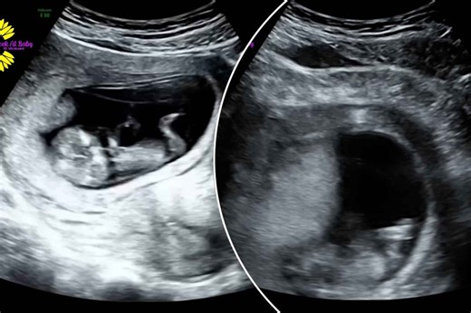 Ultrasound footage shows what happens when an expecting mother laughs during pregnancy