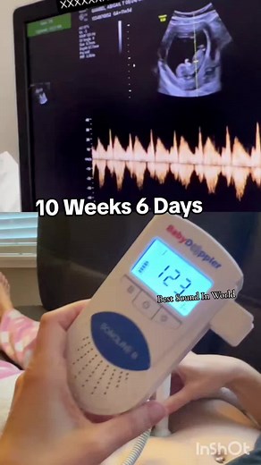 Witness the Magical Sound of Your Baby's Heartbeat at 10 Weeks Ultrasound
