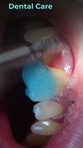 Professional Teeth Cleaning | Dental Scaling Procedure 🦷✨