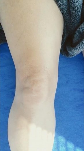 Knee Swelling assessment using the sweep test for synovial effusion