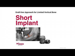 Hiossen Short Implants: A Predictable Solution for Limited Vertical Bone
