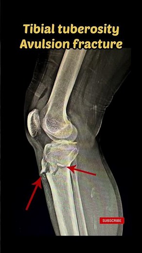 Tibial tuberosity Avulsion Fracture Xray Radiology #avulsionfracture #shorts #xray