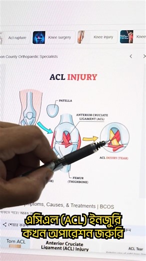 এসিএল (ACL) ইনজুরি কখন অপারেশন জরুরি