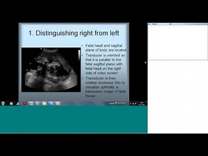 Fetal Echocardiography Basic Views by Dr Sejal Shah