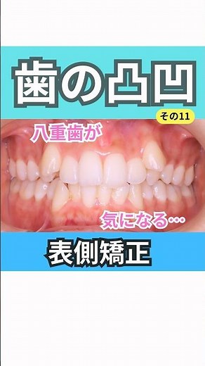 歯の凸凹を治す矯正症例動画です。上下左右4番抜歯、アンカースクリュー併用、上下表側矯正です。# #矯正歯科 #矯正症例 #叢生#アンカースクリュー#crowdedteeth